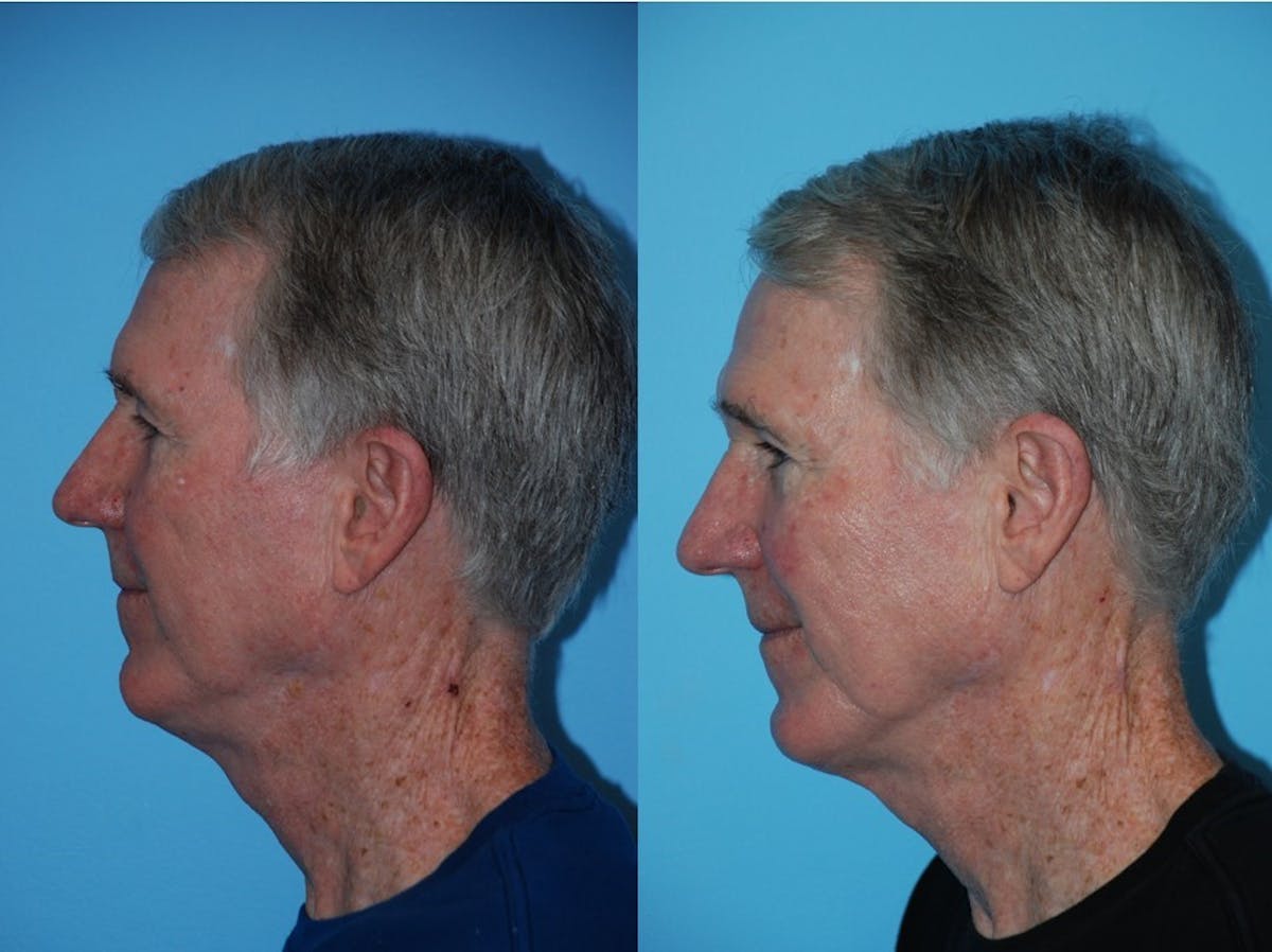 Aerolase Neo® Before & After Gallery - Patient 106387457 - Image 2