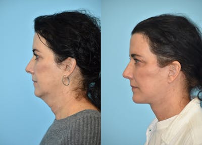 Facelift And Necklift Before & After Gallery - Patient 106387462 - Image 1