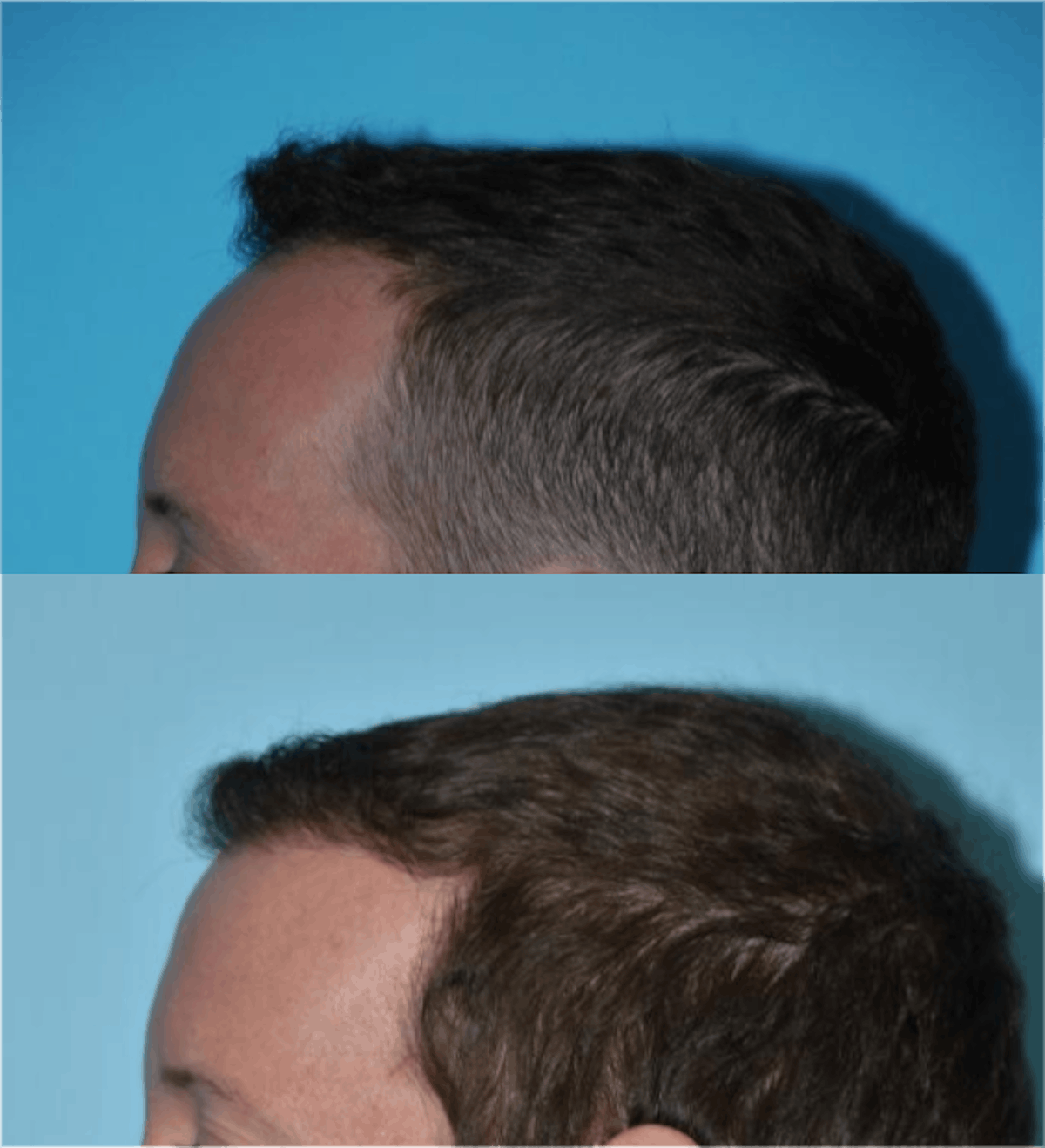 Hair Transplantation Before & After Gallery - Patient 106387456 - Image 3