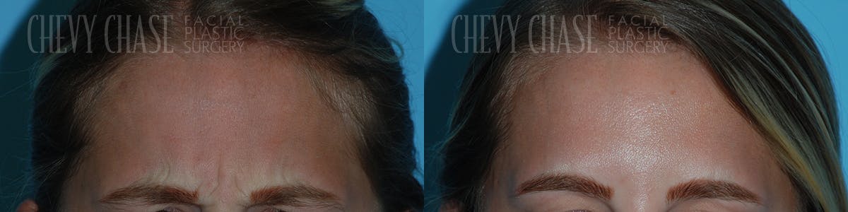Botox® / Wrinkle Treatments Before & After Gallery - Patient 106387460 - Image 2