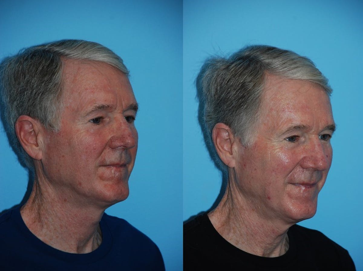 Aerolase Neo® Before & After Gallery - Patient 106387457 - Image 3