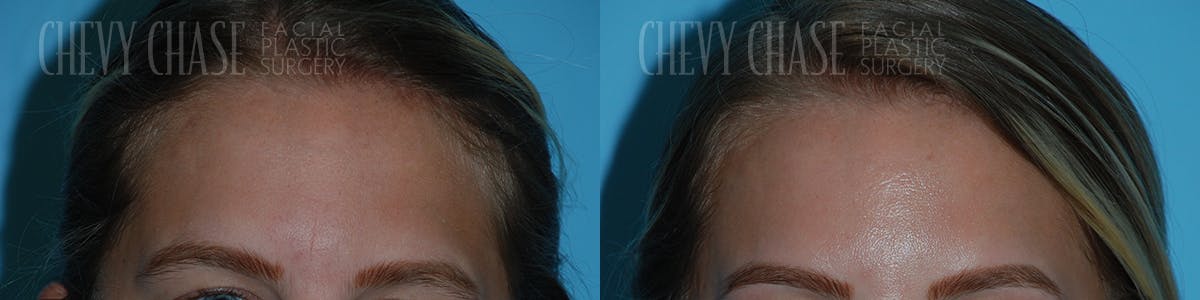 Botox® / Wrinkle Treatments Before & After Gallery - Patient 106387460 - Image 3