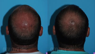 Advanced Hair Restoration Before & After Gallery - Patient 106387458 - Image 1