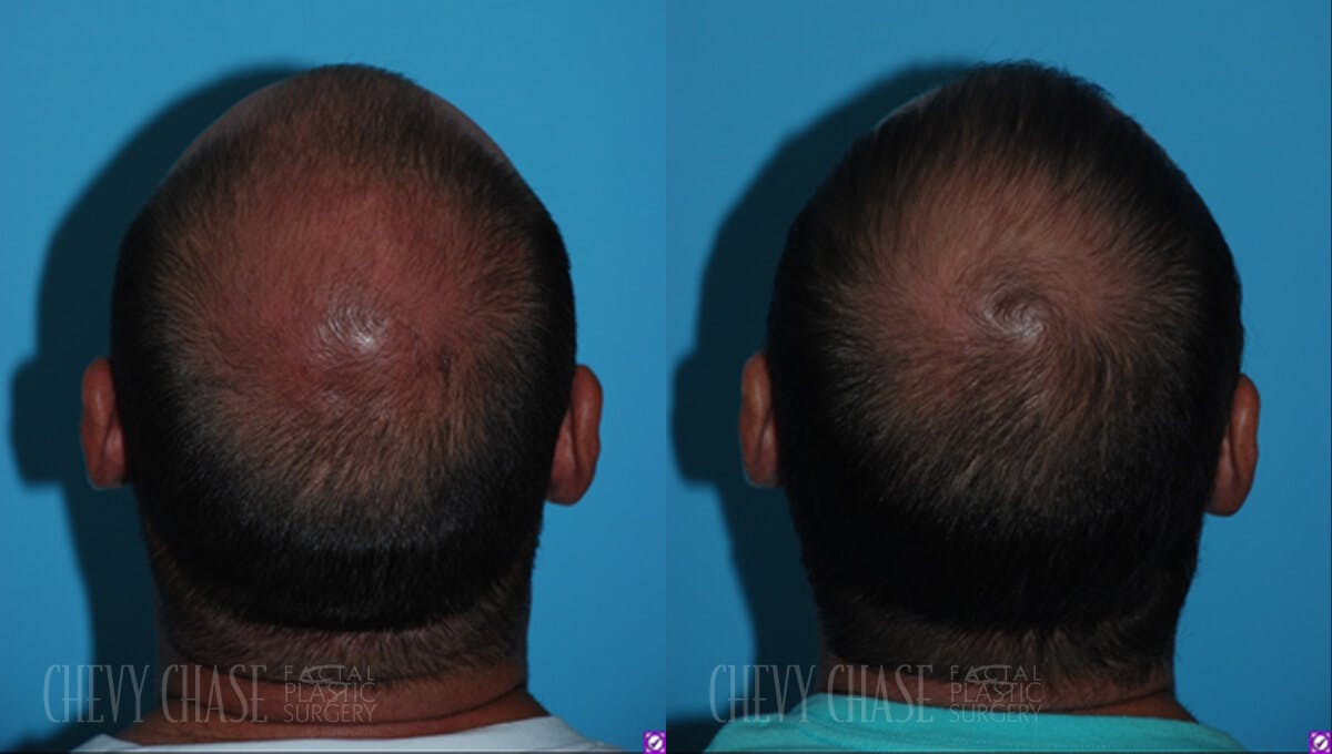 Hair Transplantation Before & After Gallery - Patient 106387458 - Image 1