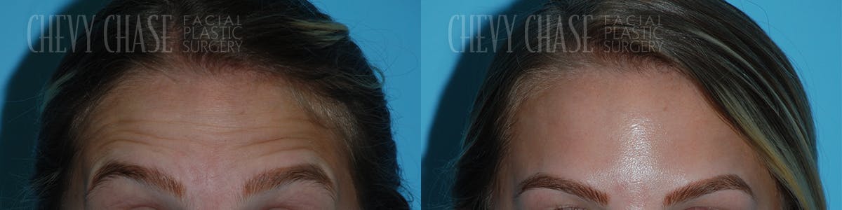 Botox® / Wrinkle Treatments Before & After Gallery - Patient 106387460 - Image 4