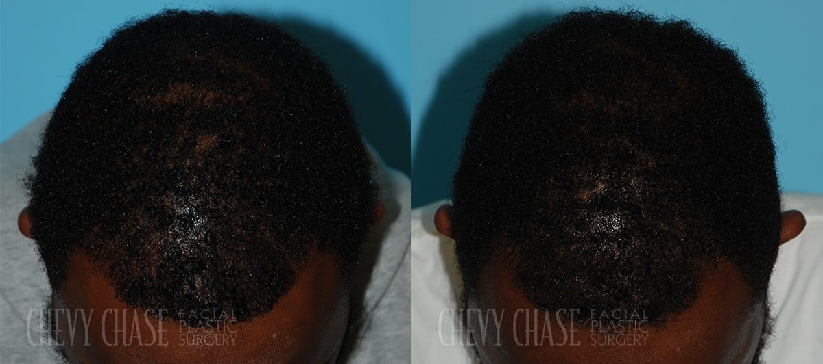 Advanced Hair Restoration Before & After Gallery - Patient 106387461 - Image 1