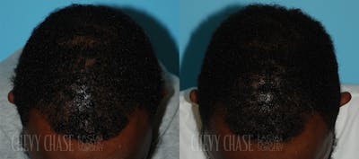 Advanced Hair Restoration Before & After Gallery - Patient 106387461 - Image 1