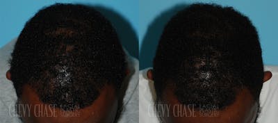 Hair Transplantation Before & After Gallery - Patient 106387461 - Image 1