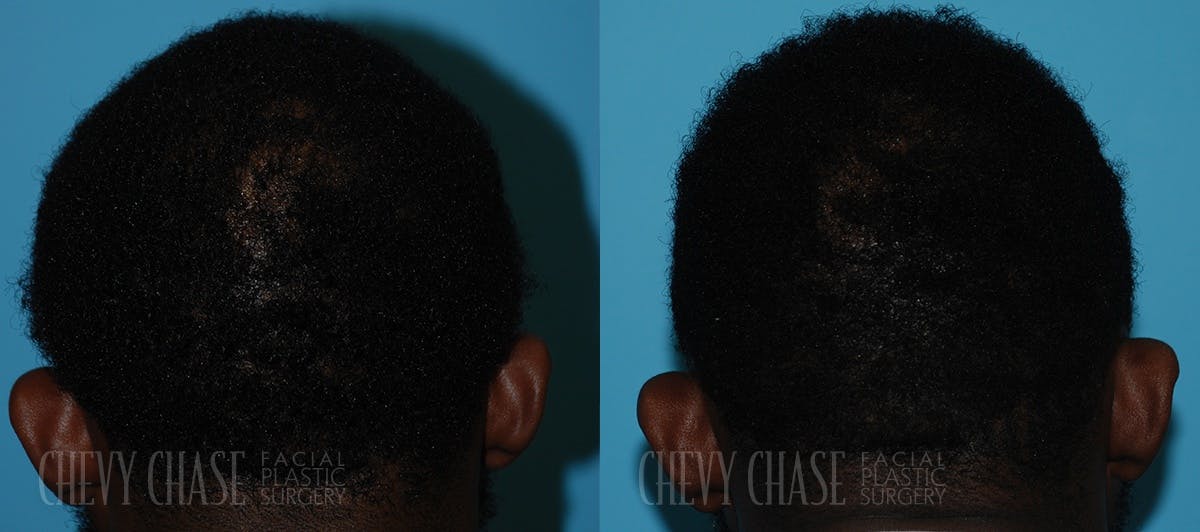 Advanced Hair Restoration Before & After Gallery - Patient 106387461 - Image 2