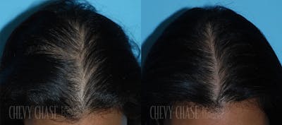 Advanced Hair Restoration Before & After Gallery - Patient 106387464 - Image 1