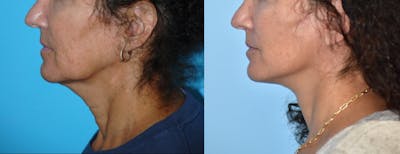Facelift And Necklift Before & After Gallery - Patient 106387469 - Image 1