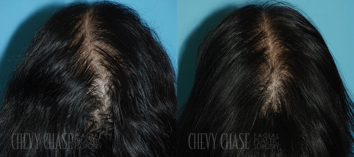 Advanced Hair Restoration Before & After Gallery - Patient 106387464 - Image 2