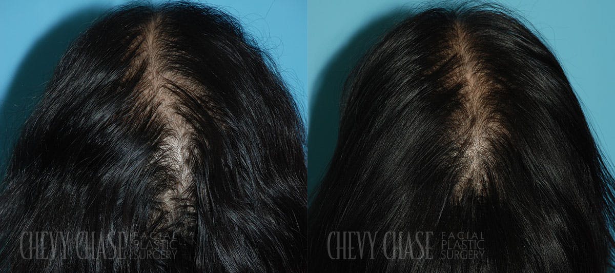 Hair Transplantation Before & After Gallery - Patient 106387464 - Image 2