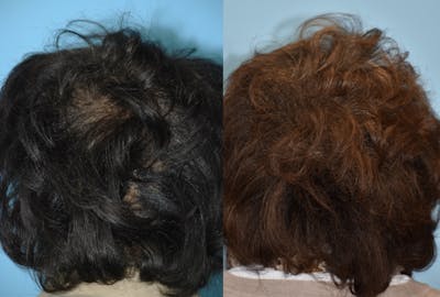 Advanced Hair Restoration Before & After Gallery - Patient 106387470 - Image 1