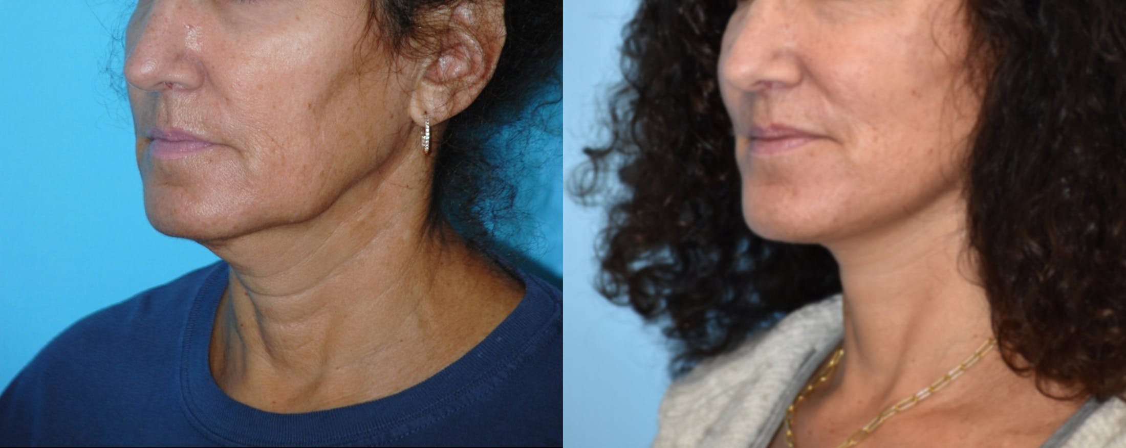 Facelift And Necklift Before & After Gallery - Patient 106387469 - Image 2