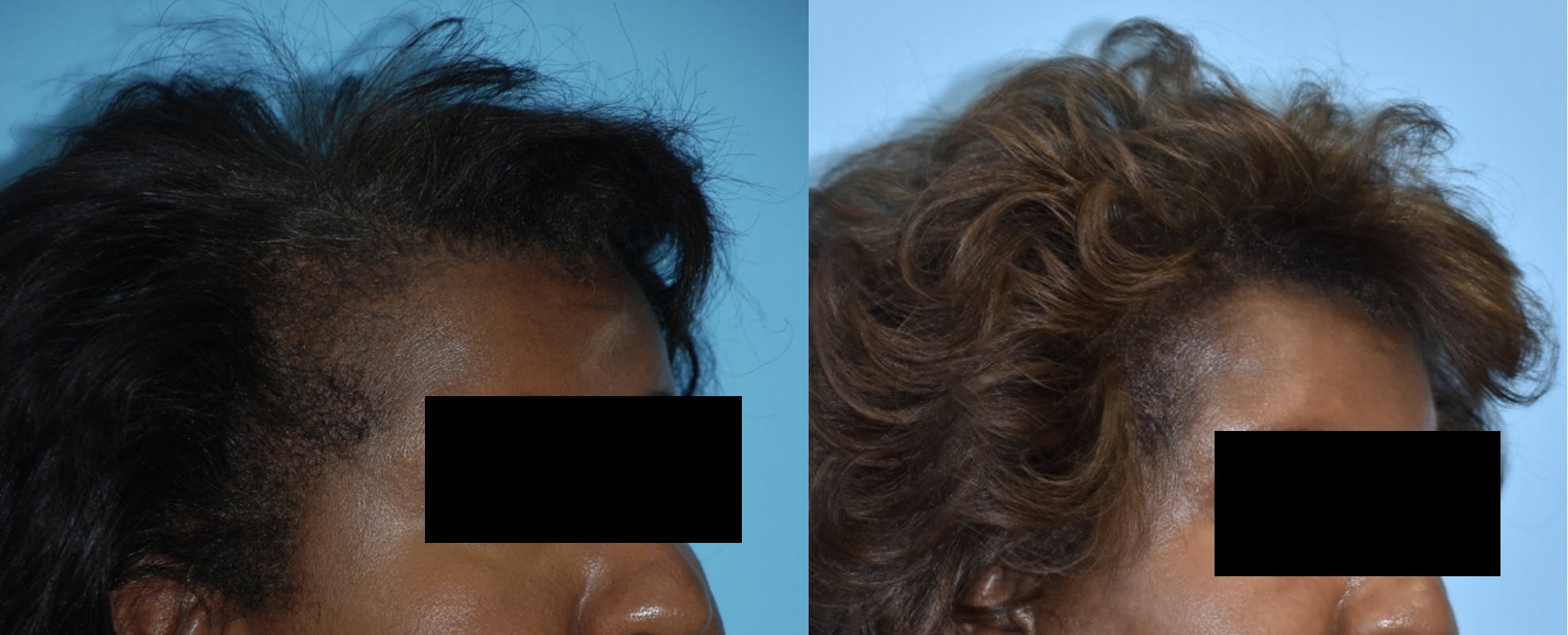 Hair Transplantation Before & After Gallery - Patient 106387470 - Image 2