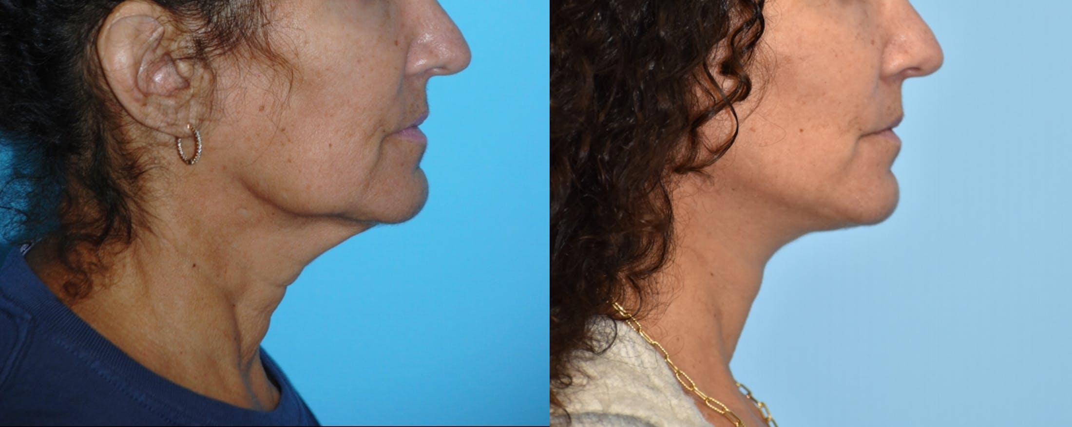 Facelift And Necklift Before & After Gallery - Patient 106387469 - Image 3