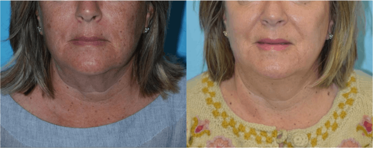 Chemical Peels Before & After Gallery - Patient 106387471 - Image 1