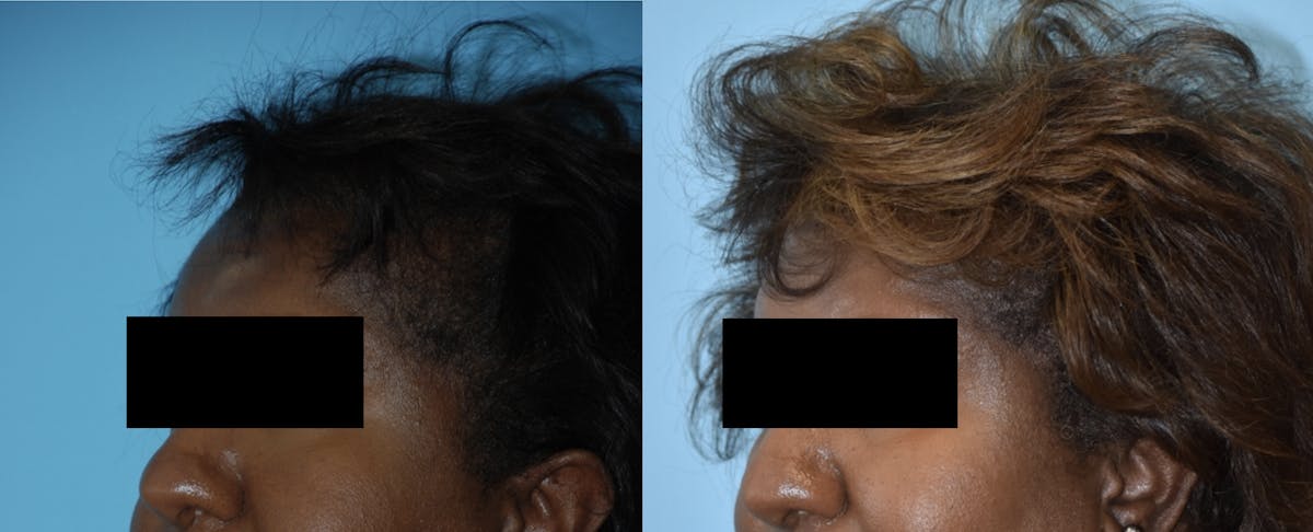 Advanced Hair Restoration Before & After Gallery - Patient 106387470 - Image 3