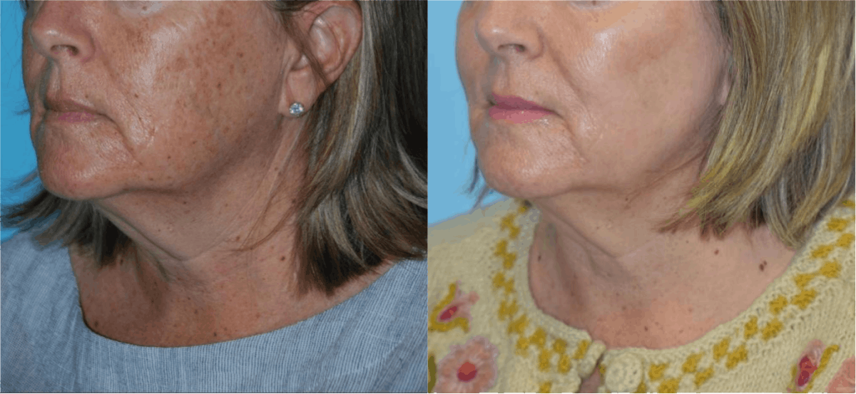 Chemical Peels Before & After Gallery - Patient 106387471 - Image 2
