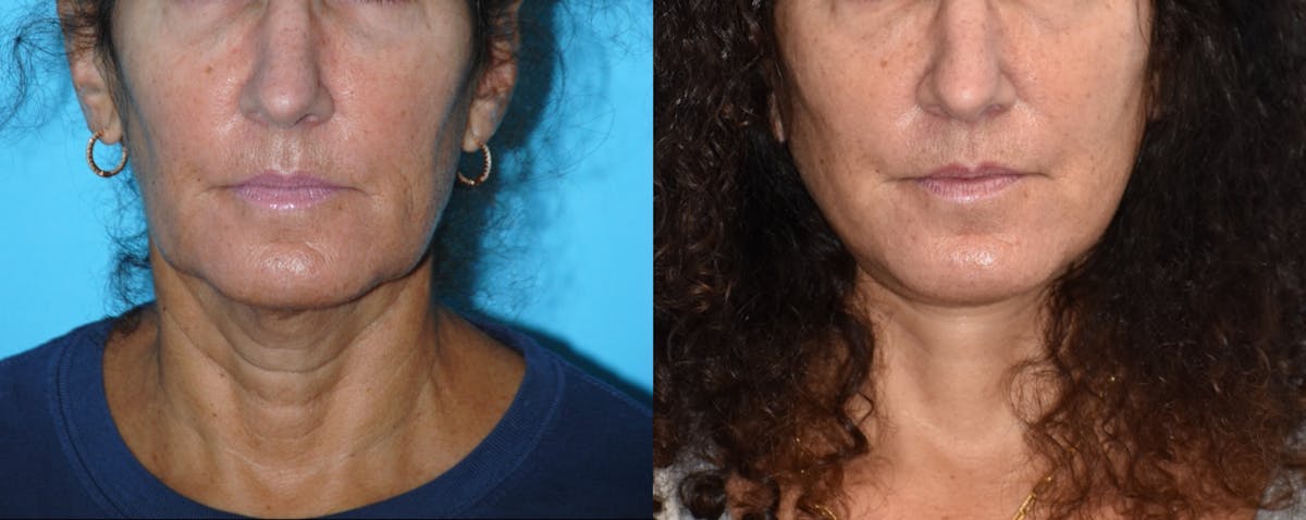 Facelift And Necklift Before & After Gallery - Patient 106387469 - Image 4