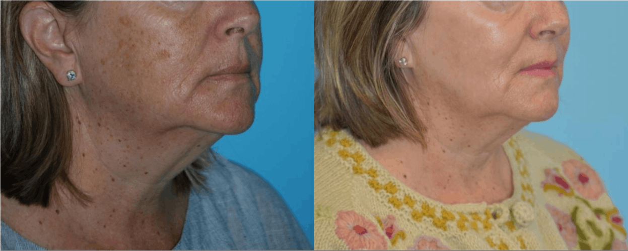 Chemical Peels Before & After Gallery - Patient 106387471 - Image 3