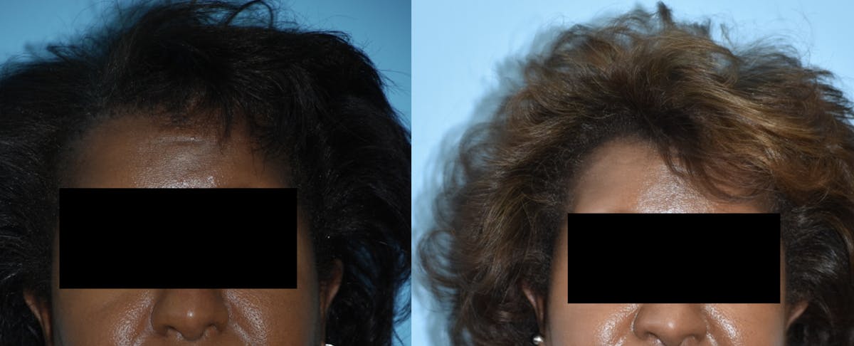 Advanced Hair Restoration Before & After Gallery - Patient 106387470 - Image 4