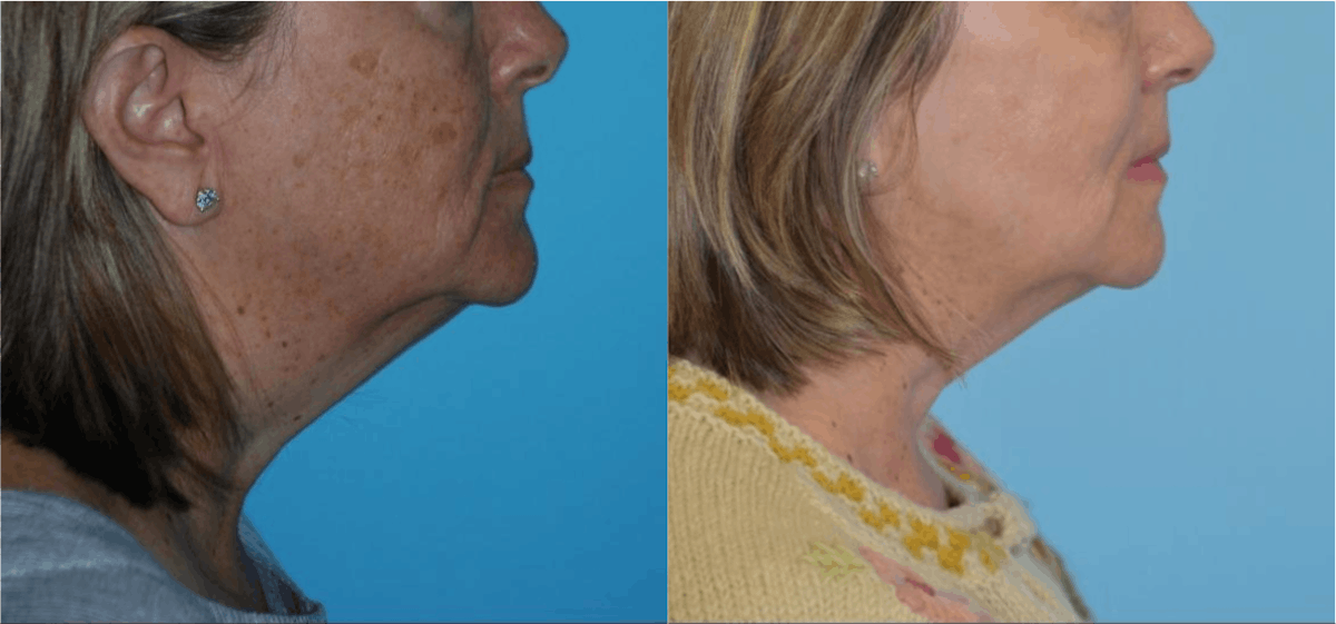 Chemical Peels Before & After Gallery - Patient 106387471 - Image 4