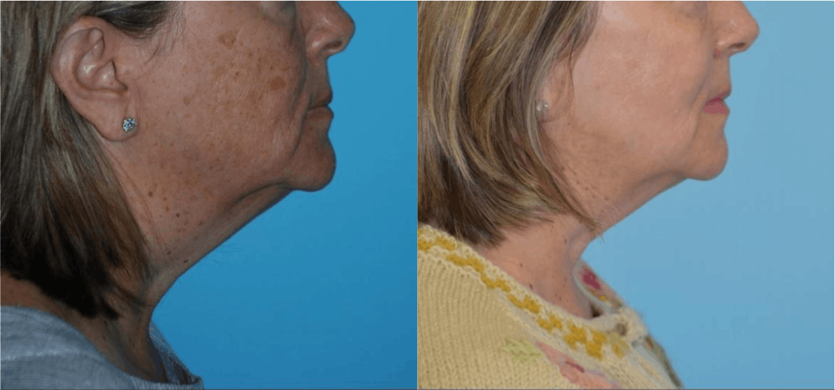 Chemical Peels Before & After Gallery - Patient 106387471 - Image 4