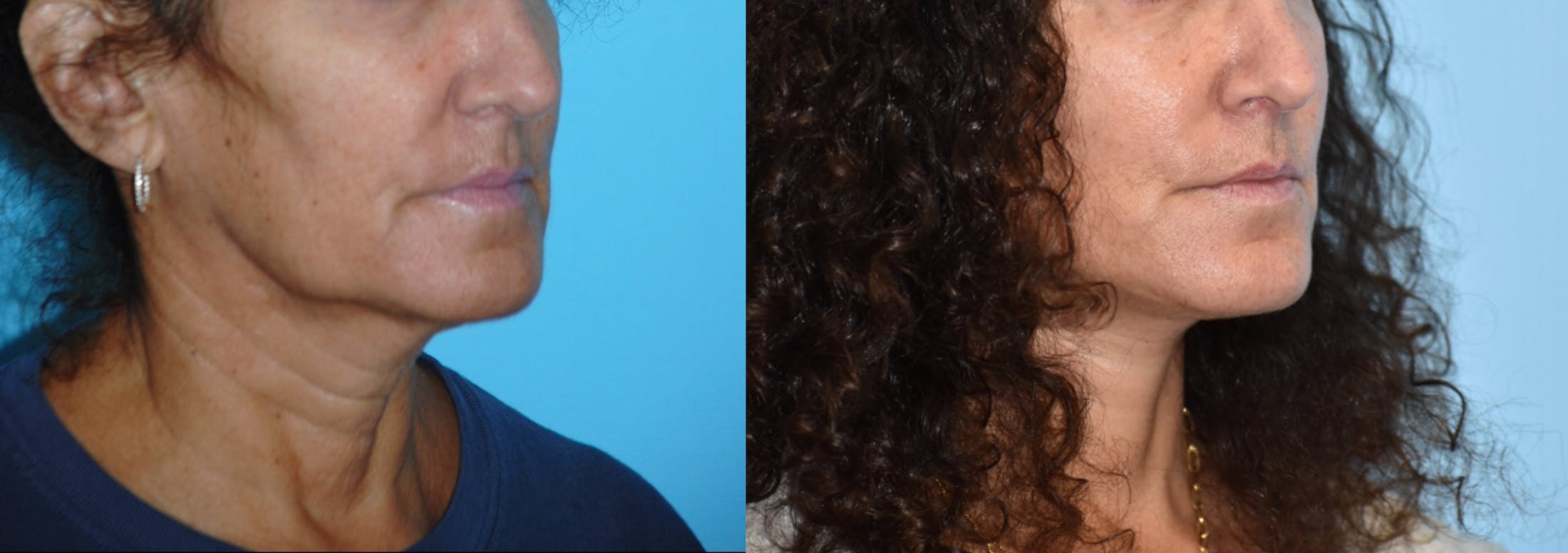 Facelift And Necklift Before & After Gallery - Patient 106387469 - Image 5