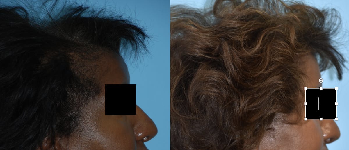 Advanced Hair Restoration Before & After Gallery - Patient 106387470 - Image 5