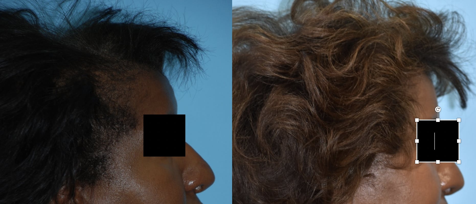 Hair Transplantation Before & After Gallery - Patient 106387470 - Image 5