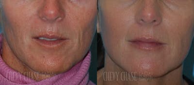 Combination Treatments Before & After Gallery - Patient 106387468 - Image 1