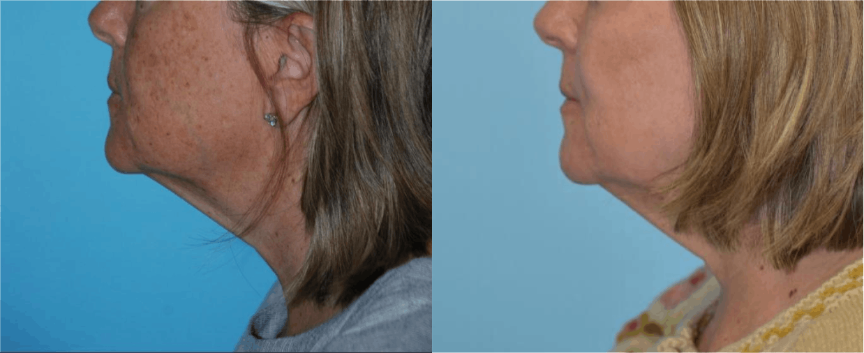 Chemical Peels Before & After Gallery - Patient 106387471 - Image 5