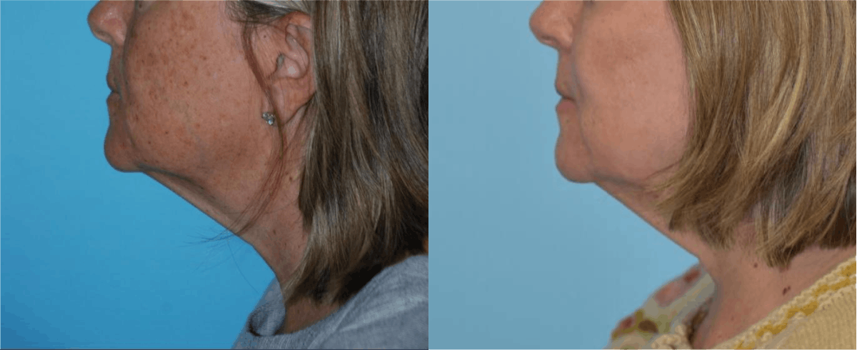 Chemical Peels Before & After Gallery - Patient 106387471 - Image 5