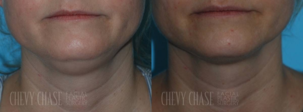 Combination Treatments Before & After Gallery - Patient 106387475 - Image 1