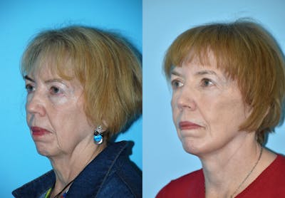 Facelift And Necklift Before & After Gallery - Patient 106387484 - Image 1