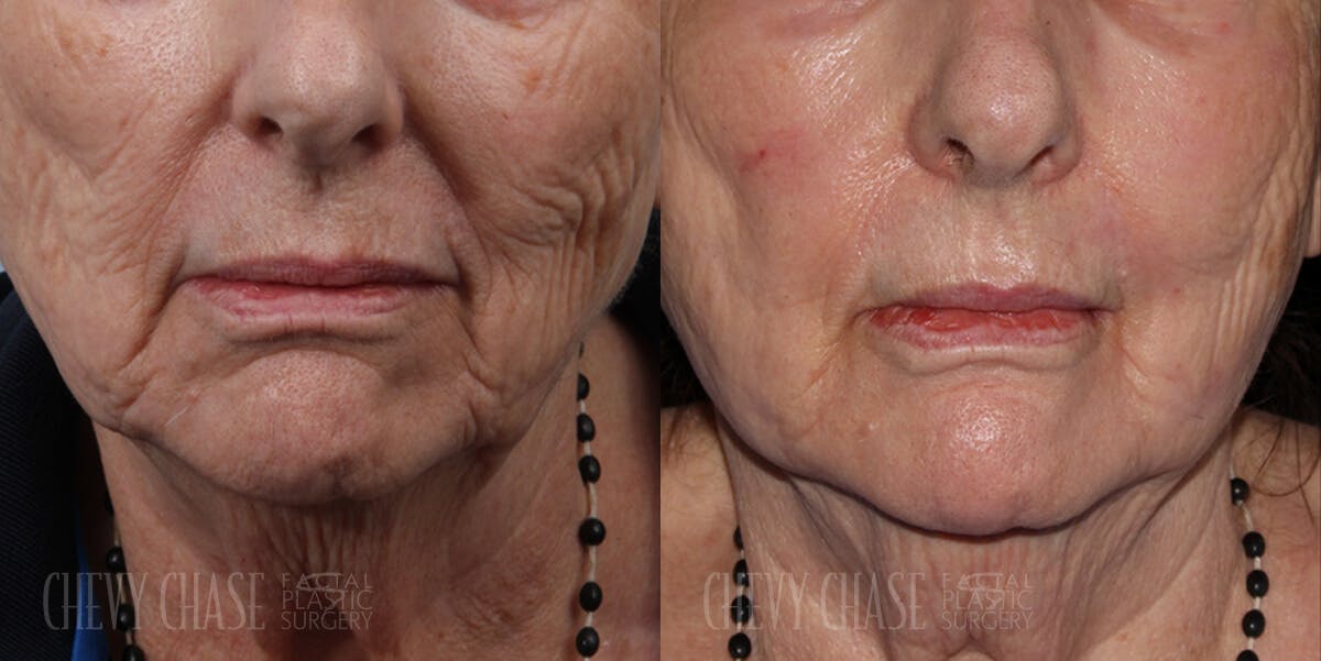 Chemical Peels Before & After Gallery - Patient 106387473 - Image 1