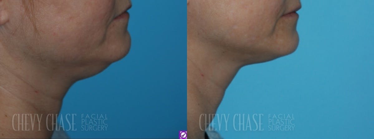 Combination Treatments Before & After Gallery - Patient 106387475 - Image 2