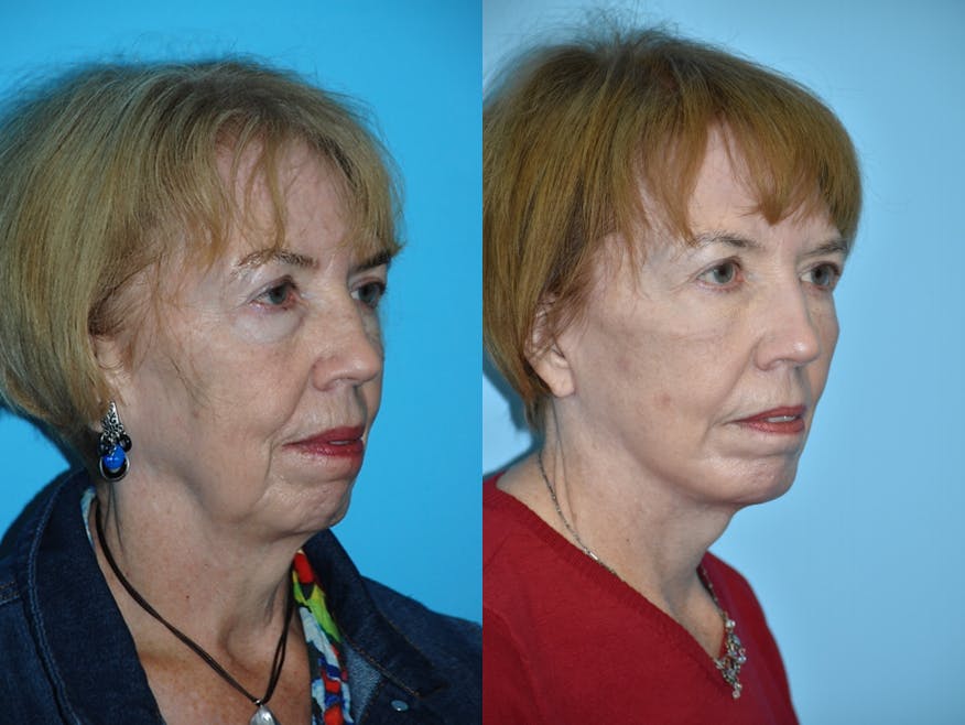 Facelift And Necklift Before & After Gallery - Patient 106387484 - Image 2