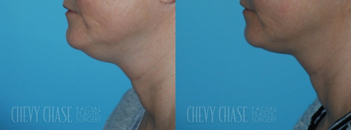 Combination Treatments Before & After Gallery - Patient 106387475 - Image 3