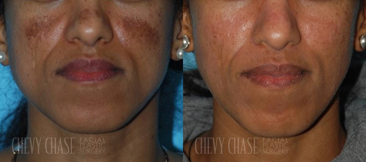 Chemical Peels Before & After Gallery - Patient 106387485 - Image 1