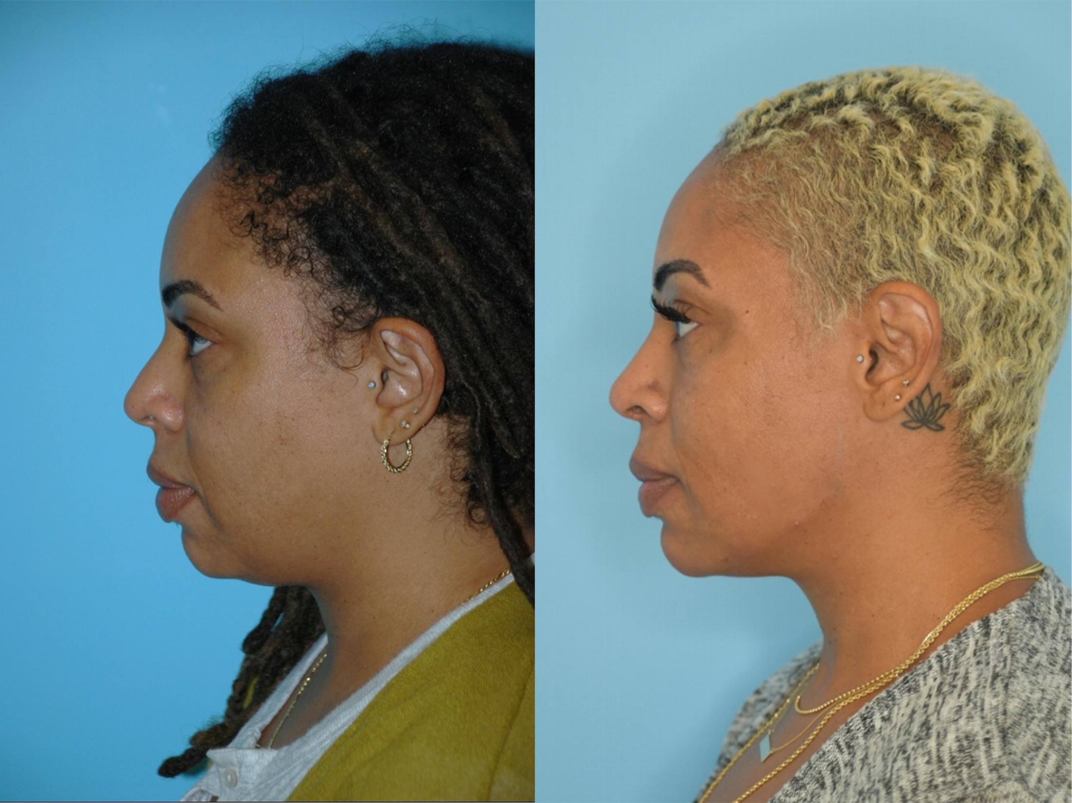 Dermal Fillers Before & After Gallery - Patient 106387483 - Image 1