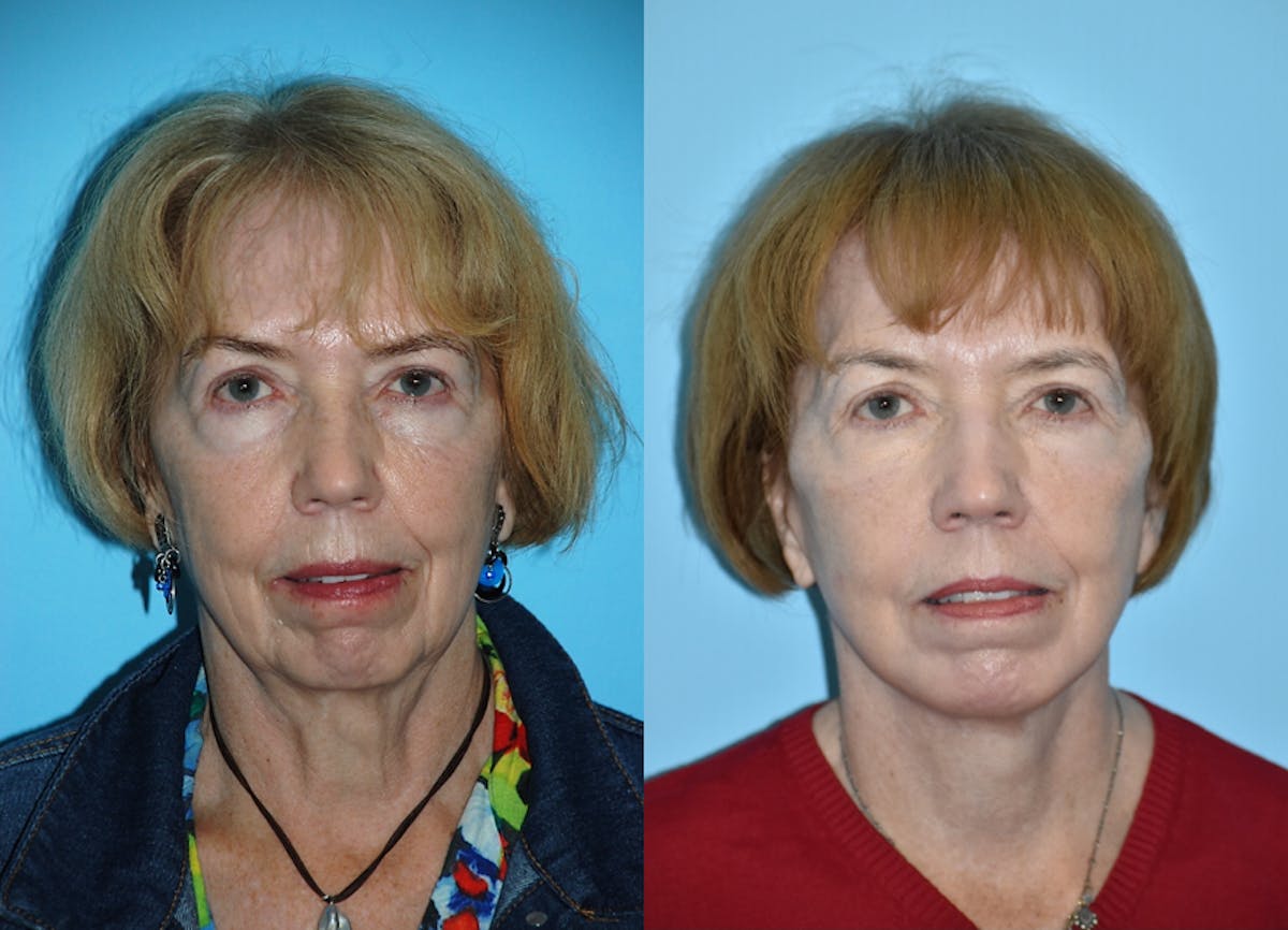 Facelift And Necklift Before & After Gallery - Patient 106387484 - Image 3