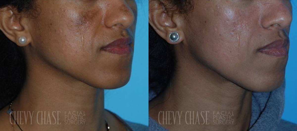 Chemical Peels Before & After Gallery - Patient 106387485 - Image 2