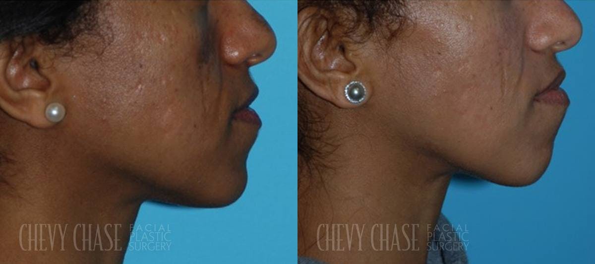 Chemical Peels Before & After Gallery - Patient 106387485 - Image 3