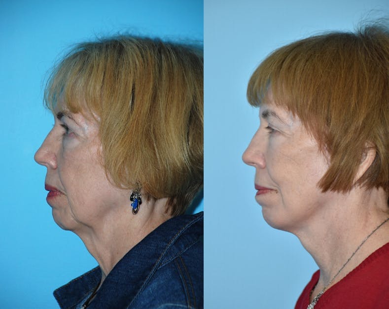 Facelift And Necklift Before & After Gallery - Patient 106387484 - Image 4