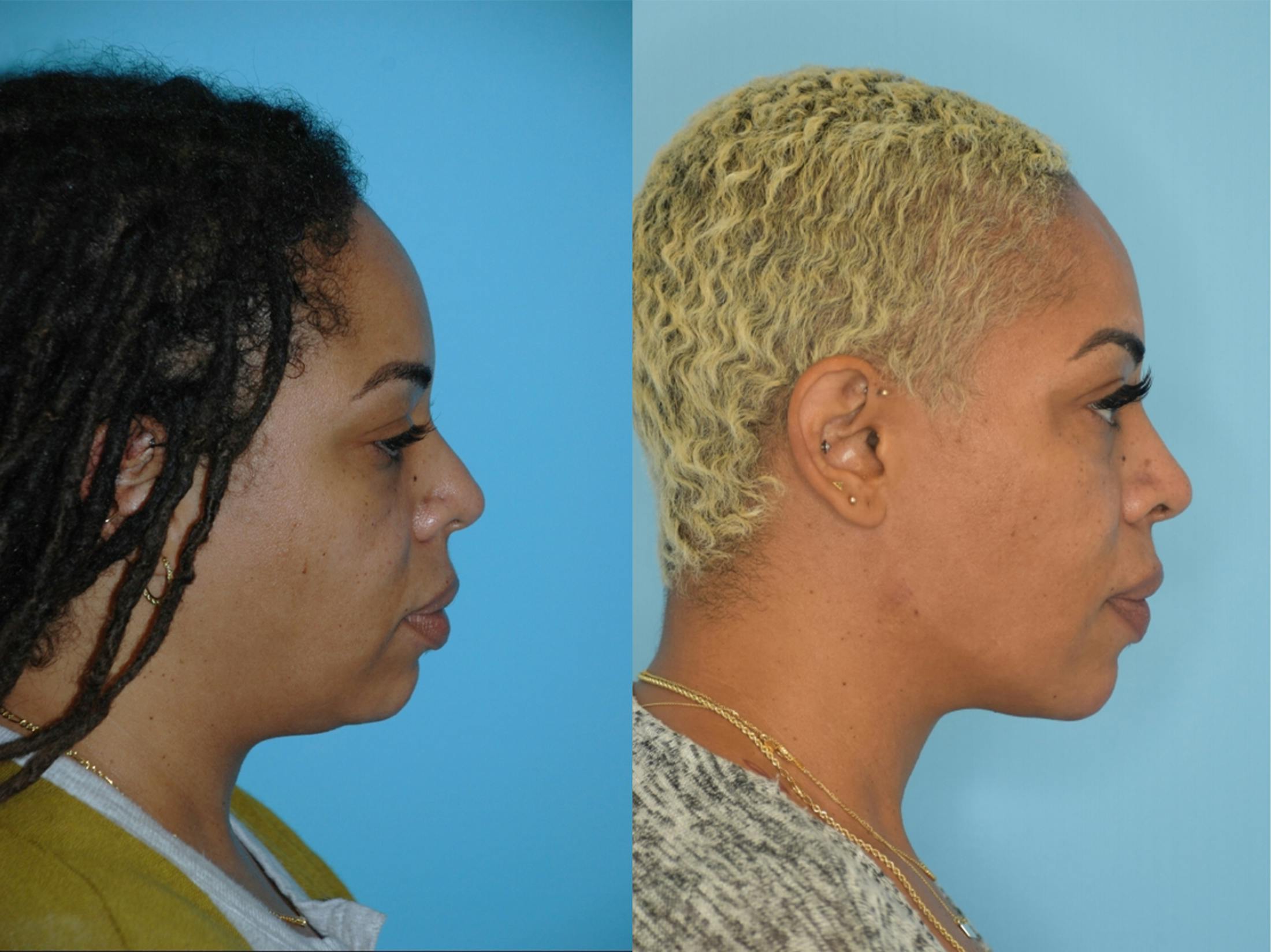 Dermal Fillers Before & After Gallery - Patient 106387483 - Image 2