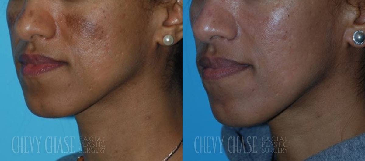 Chemical Peels Before & After Gallery - Patient 106387485 - Image 4