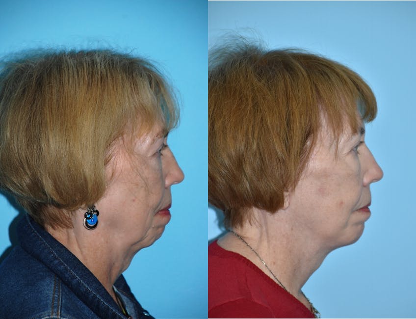 Facelift And Necklift Before & After Gallery - Patient 106387484 - Image 5